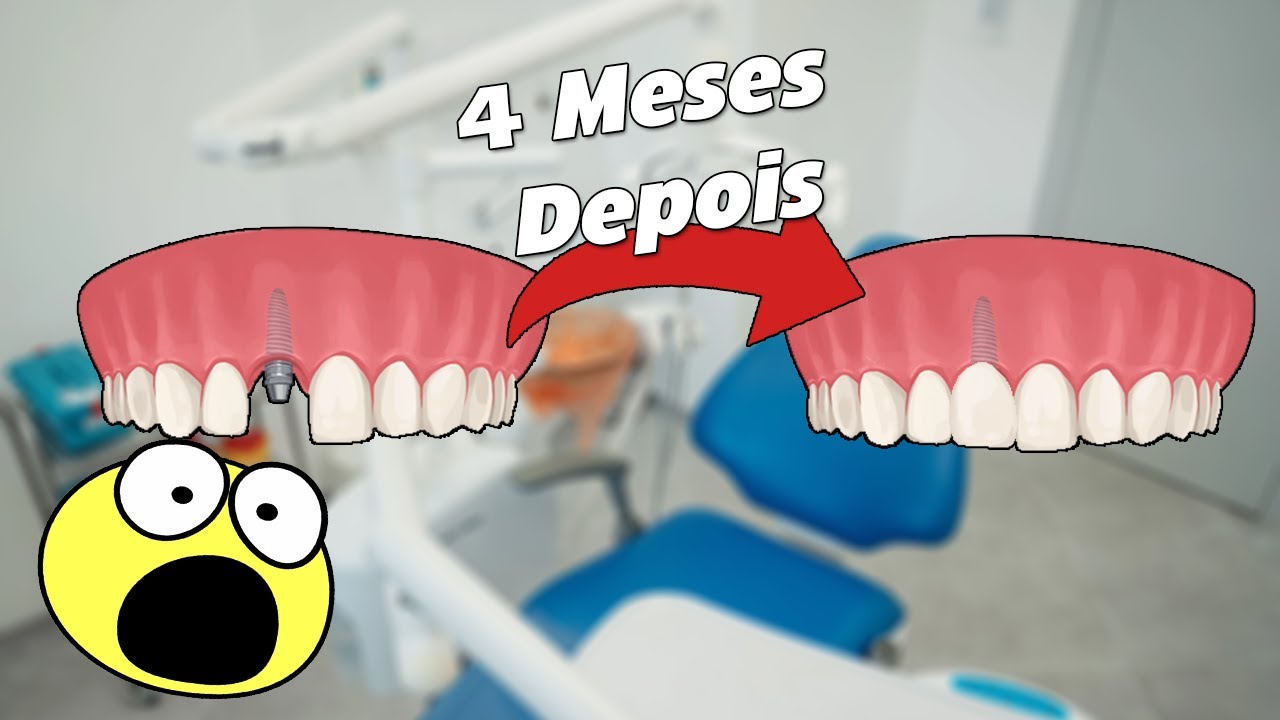 Implante Dentário 5 Coisas que Você é OBRIGADO a Saber