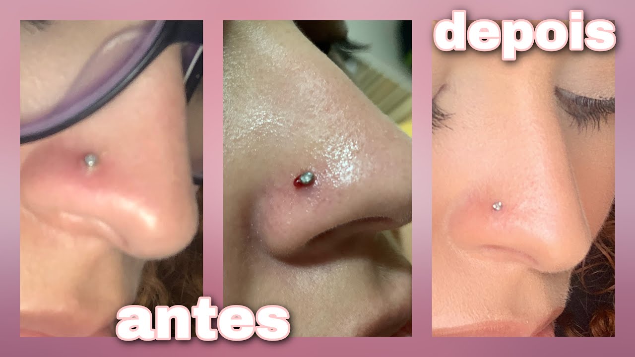 COMO CUIDAR DO PIERCING INFLAMADO Tchau Queloide