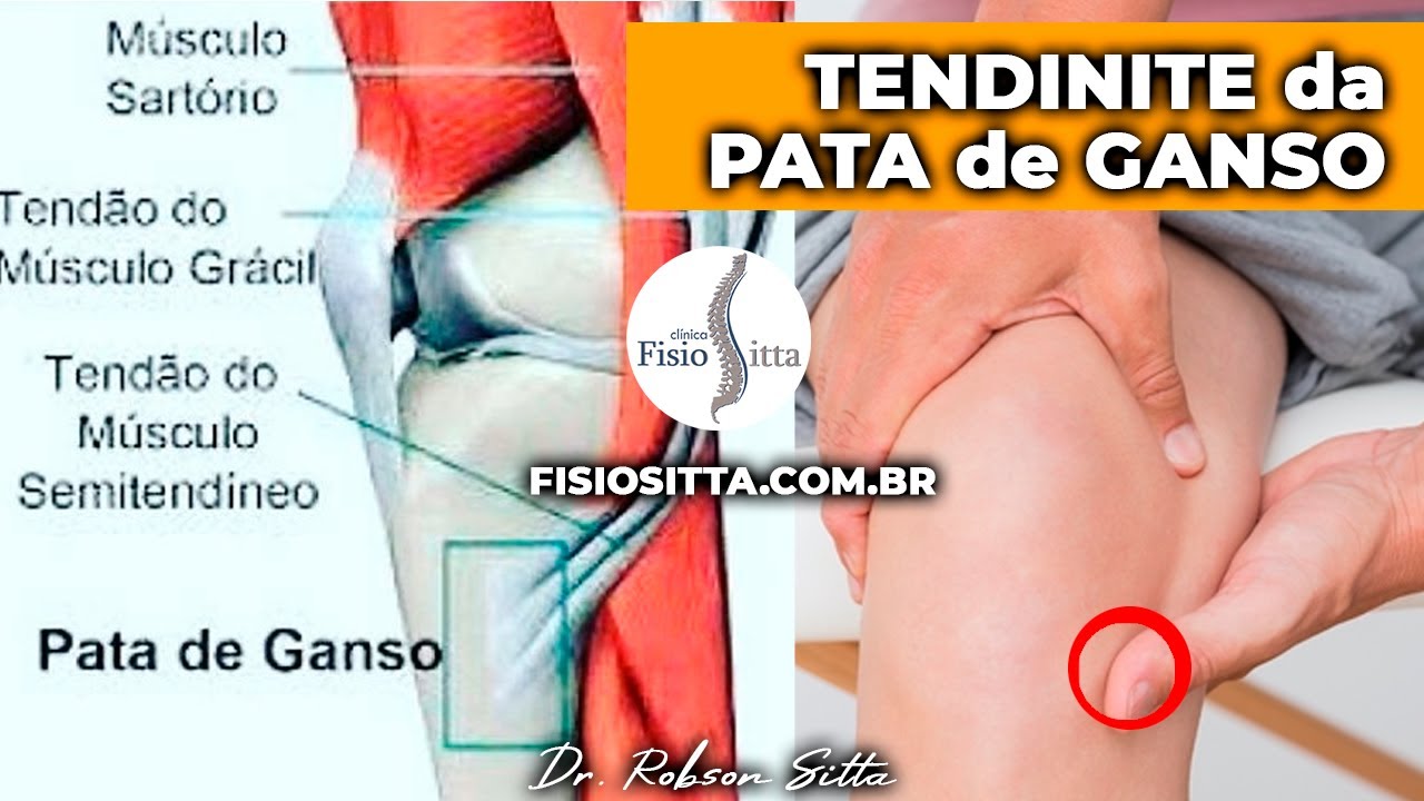 Tendinopatia Do Gastrocn Mio Medial Braincp