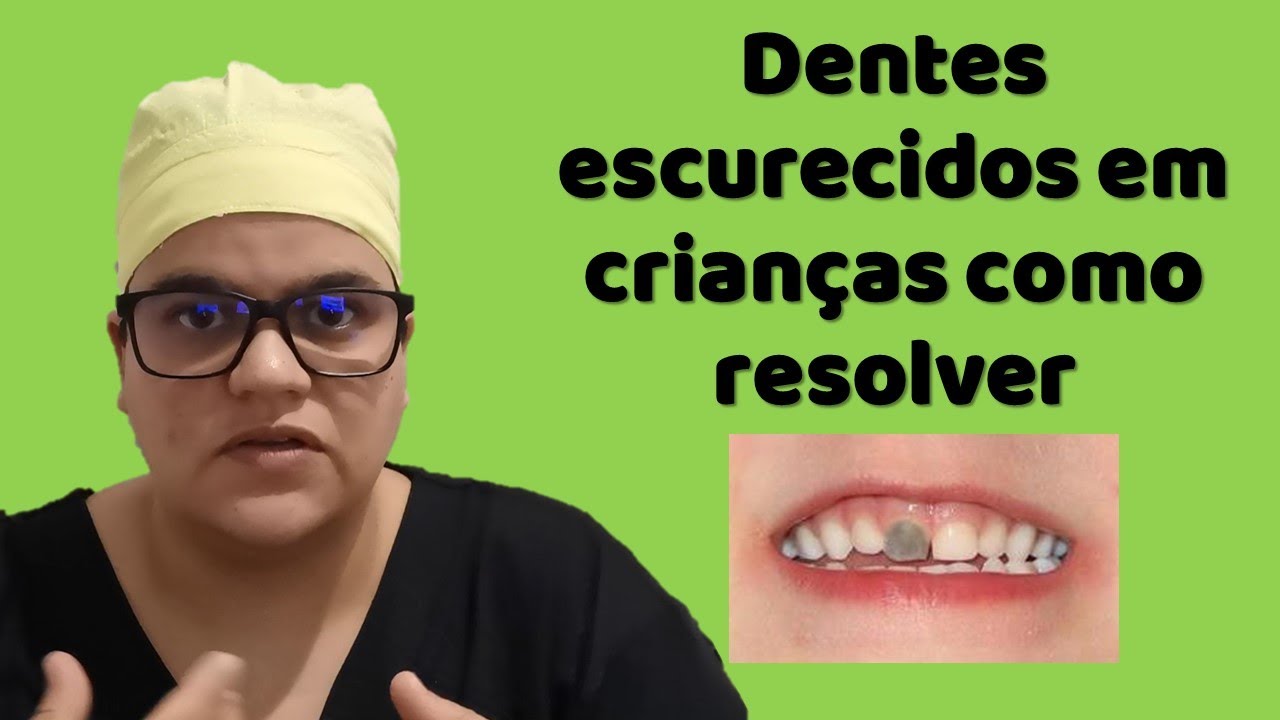 Como clarear dente de criança escurecido causas e tratamentos Dra