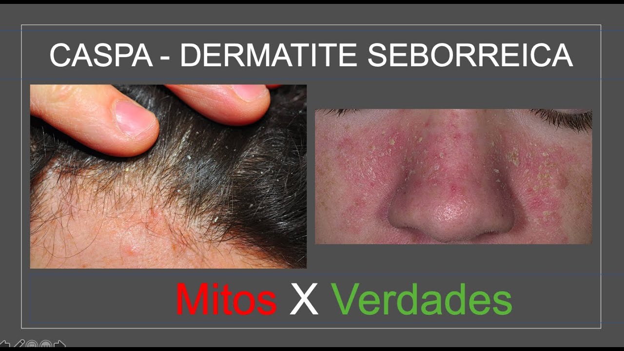 Dermatite Seborreica Mitos E Verdades O Dermatologista Luiz Gameiro