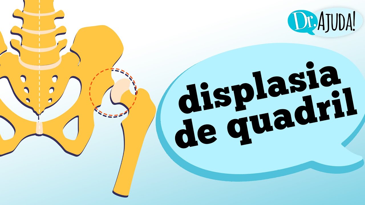 Displasia De Quadril Causas Sintomas E Tratamento