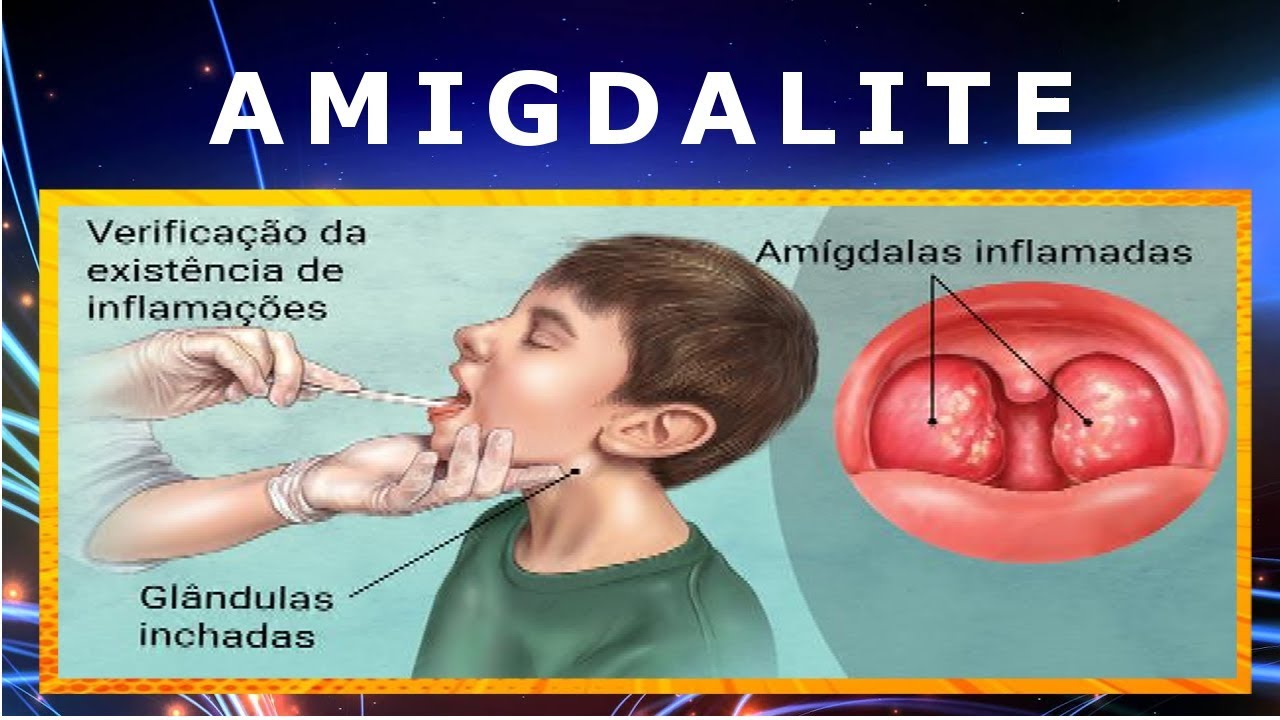 Rem Dios Caseiros Para Acabar A Amigdalite Dicas Eficientes E