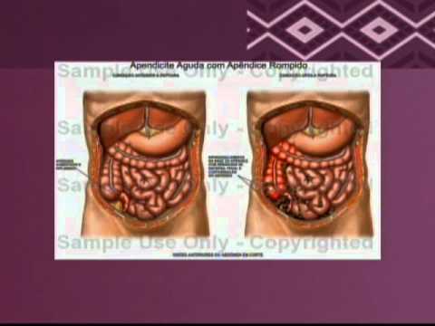 Apendicite Causas Sintomas E Tratamento Completo