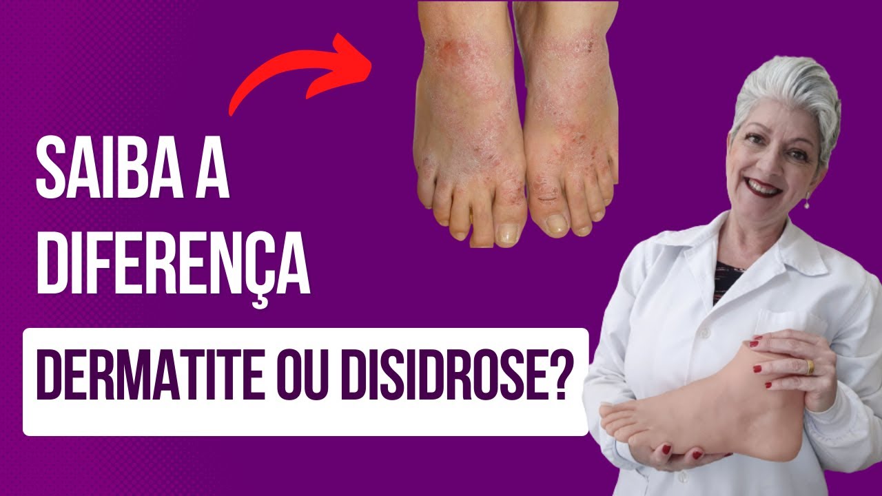 Dermatite Ou Disidrose Entenda As Diferen As E Sintomas