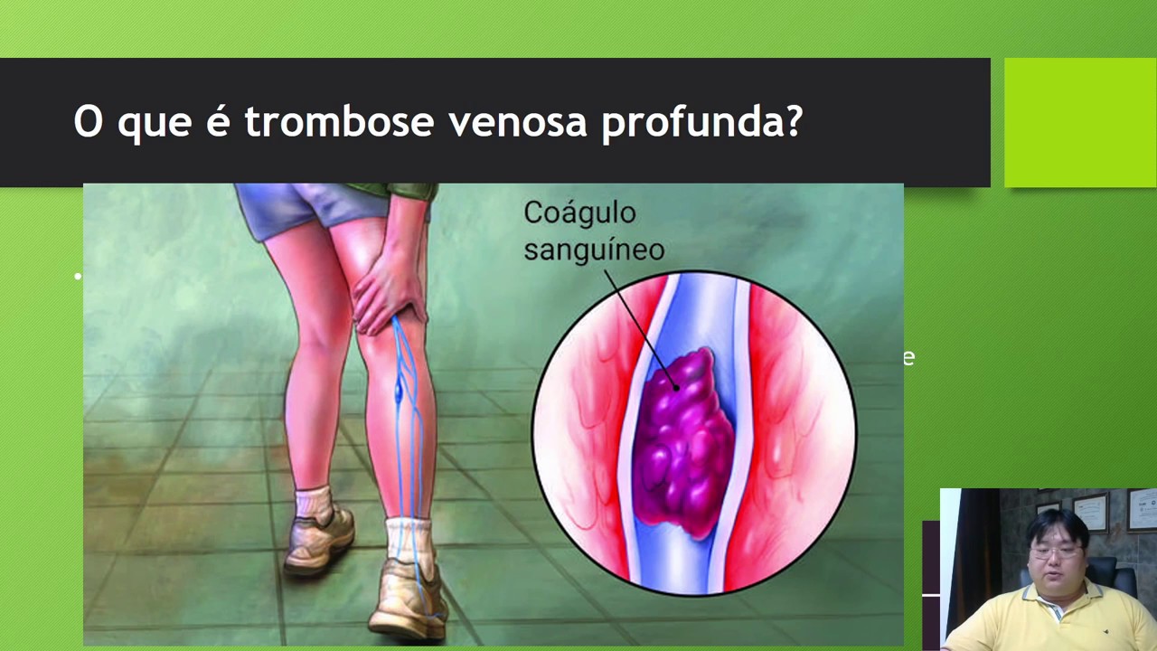 O que é trombose venosa profunda e quais são seus sintomas e tratamentos