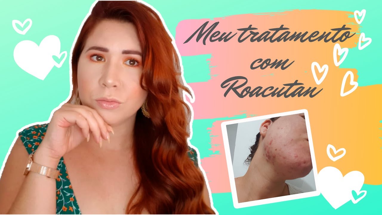 ROACUTAN COMO ELIMINEI MINHAS ESPINHAS Meu Tratamento Com Roacutan Fim Das ACNES