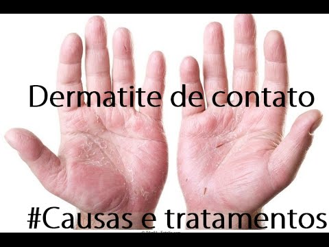 Dermatite De Contato Causas E Tratamentos