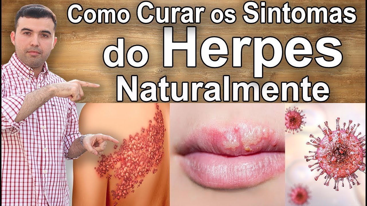 Curar Herpes Em Casa - Como Curar e Tratar Herpes Naturalmente