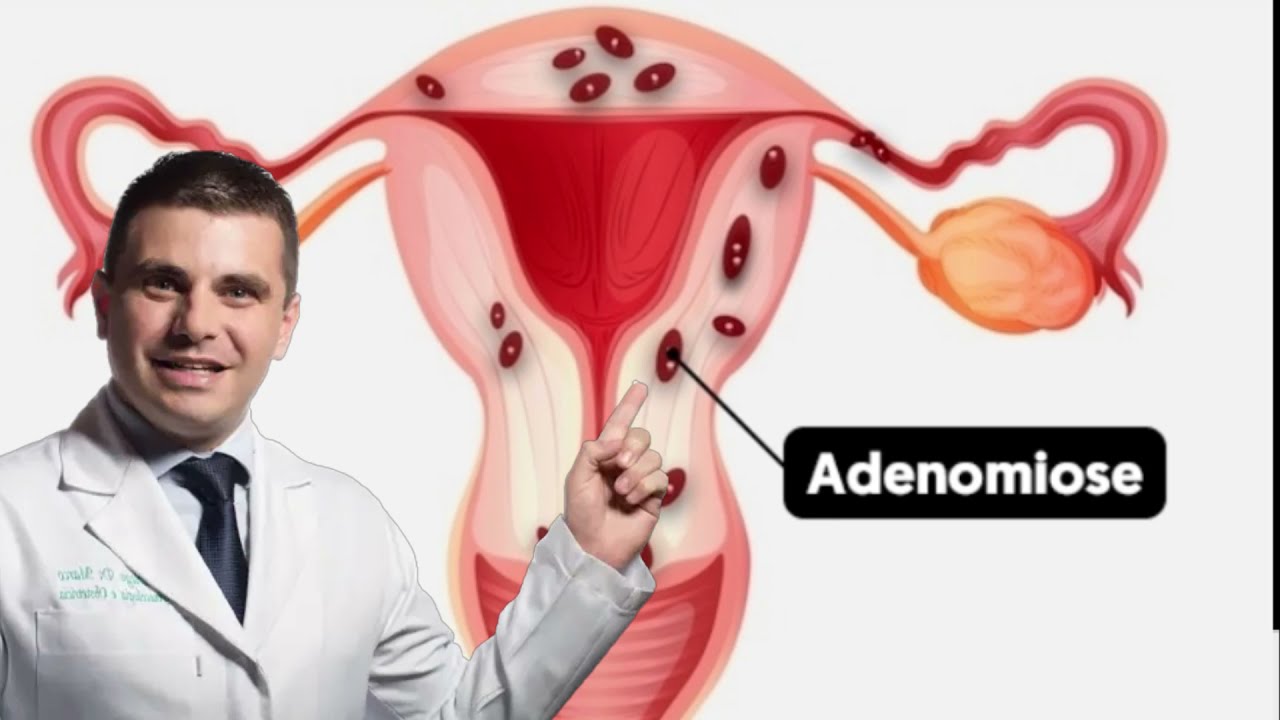 Adenomiose: Sintomas e Tratamento para Problemas no Útero