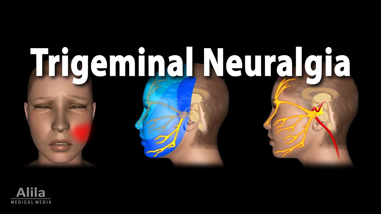 Animação sobre Neuralgia Trigeminal (Tic Douloureux)