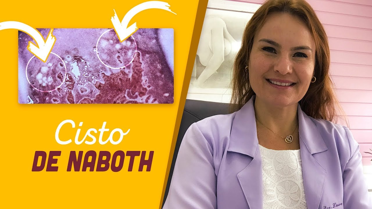 Cisto De Naboth Causas E Tratamentos Para Essa Condição No Colo Do útero 4011