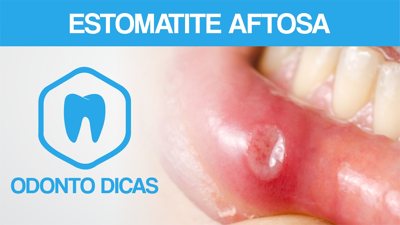 Como tratar estomatite aftosa: dicas de odontologia