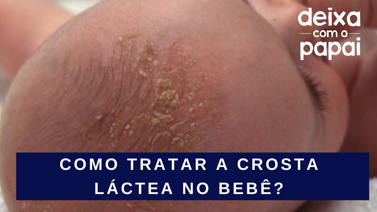 Dermatite seborreica: o que é e como tratá-la crosta láctea? Deixe comigo