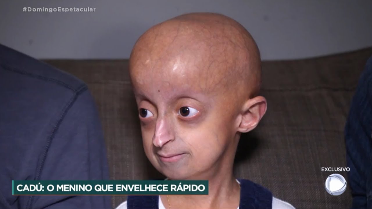 Garoto com doença rara de envelhecimento precoce: conheça sua história.