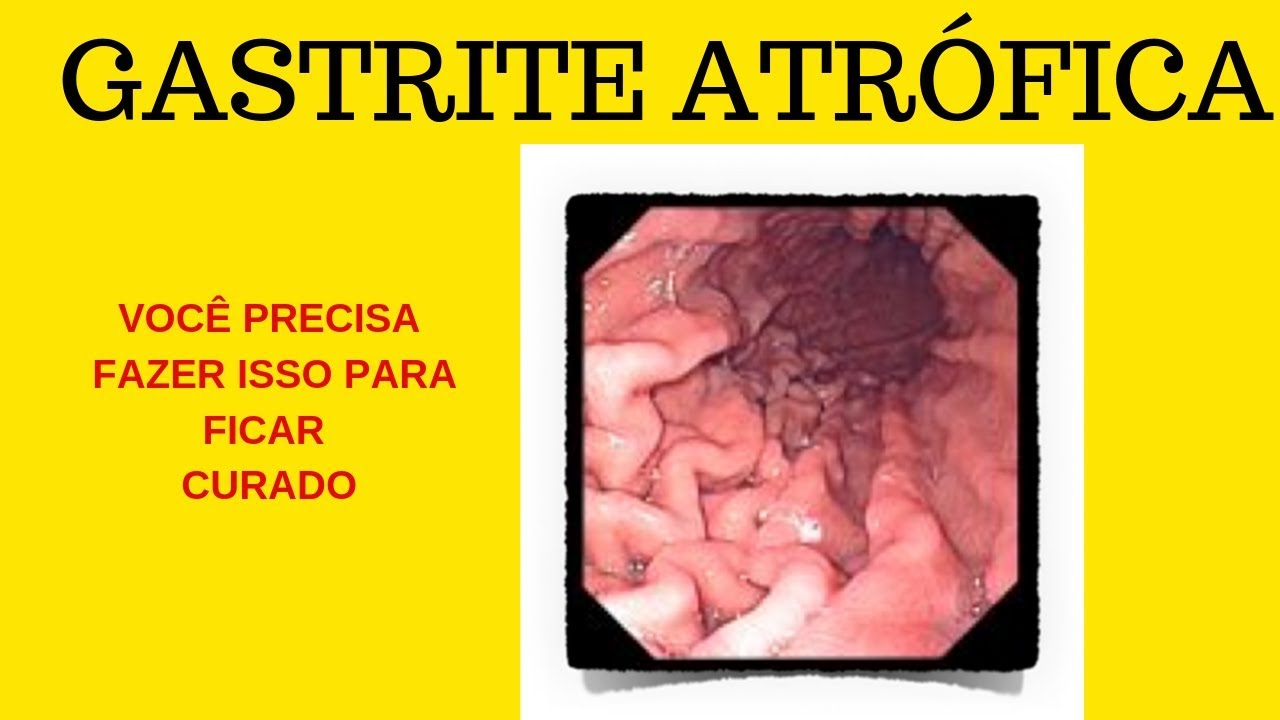 Gastrite atrófica: causas, sintomas e tratamentos