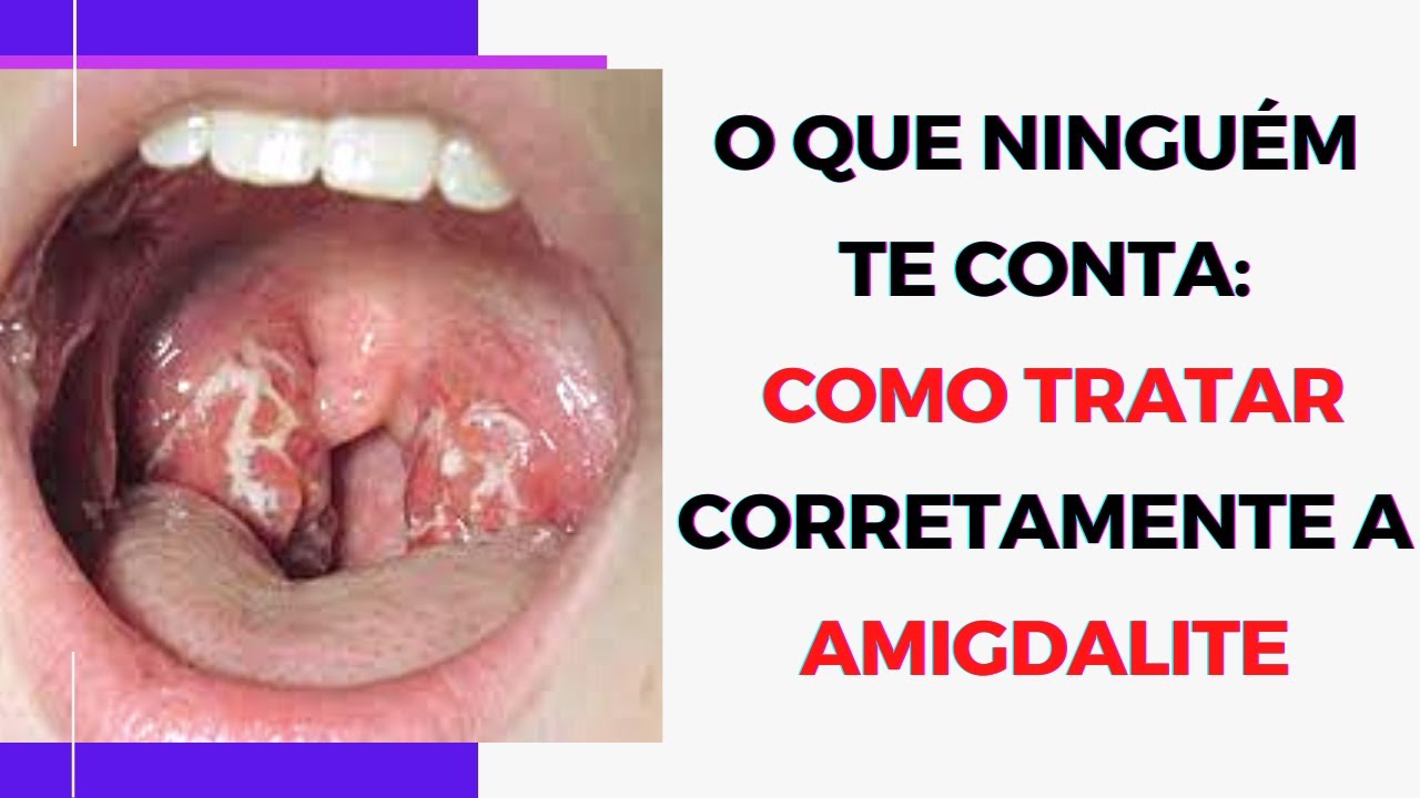 Guia completo sobre amigdalites: sintomas e tratamentos