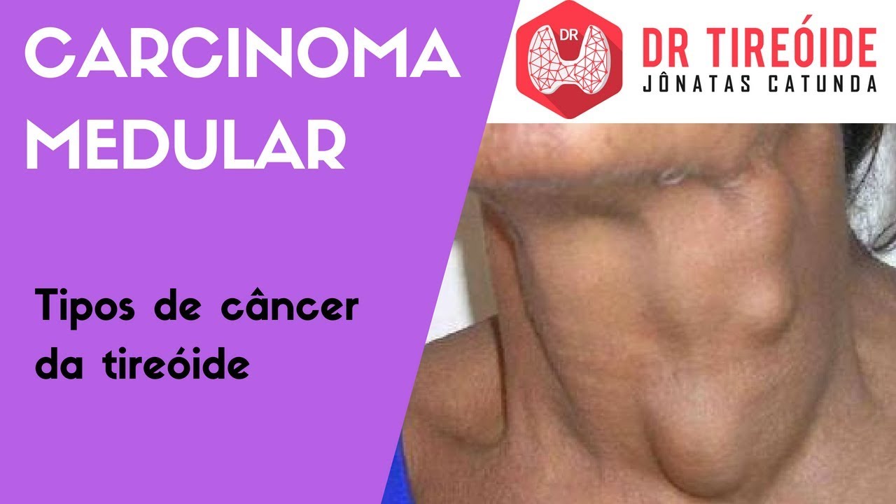 Tipos de Câncer de Tireoide Carcinoma Medular Dr Jônatas Catunda