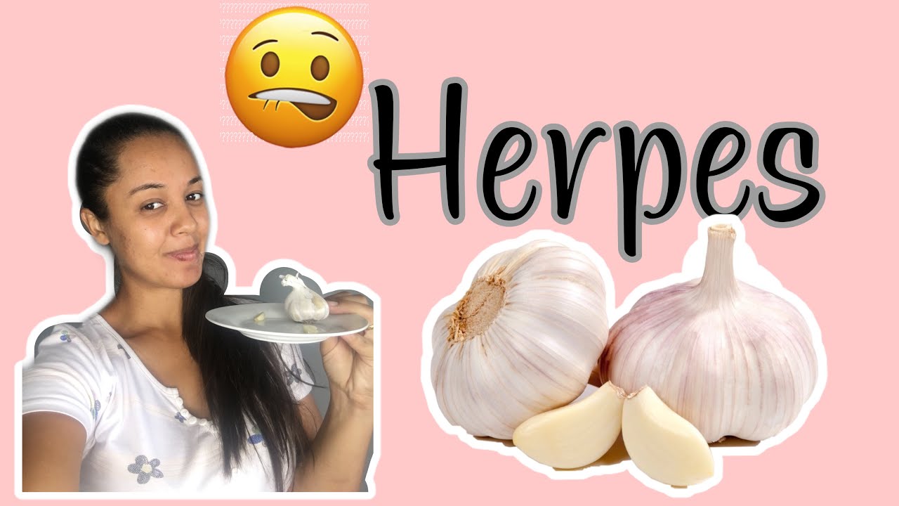 Tratamento de herpes com alho: como usar e benefícios