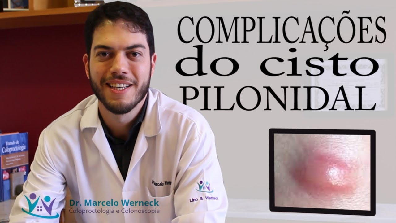 Cisto Pilonidal Complicações E Tratamentos Com Dr Marcelo Werneck 1725