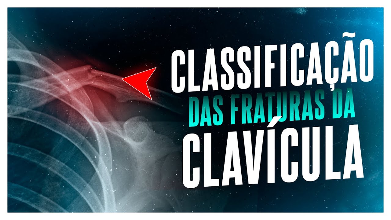 Classificação De Fraturas De Clavícula: Tipos E Tratamentos