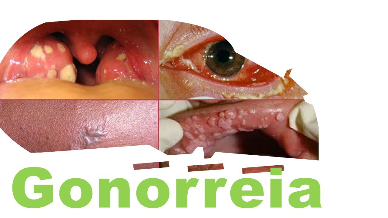 como identificar e tratar a gonorreia informações importantes