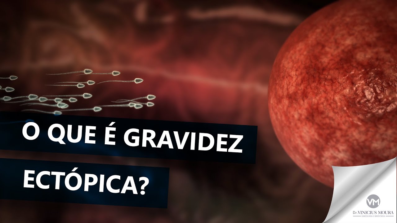 Entenda O Que é Gravidez Ectópica E Seus Sintomas 