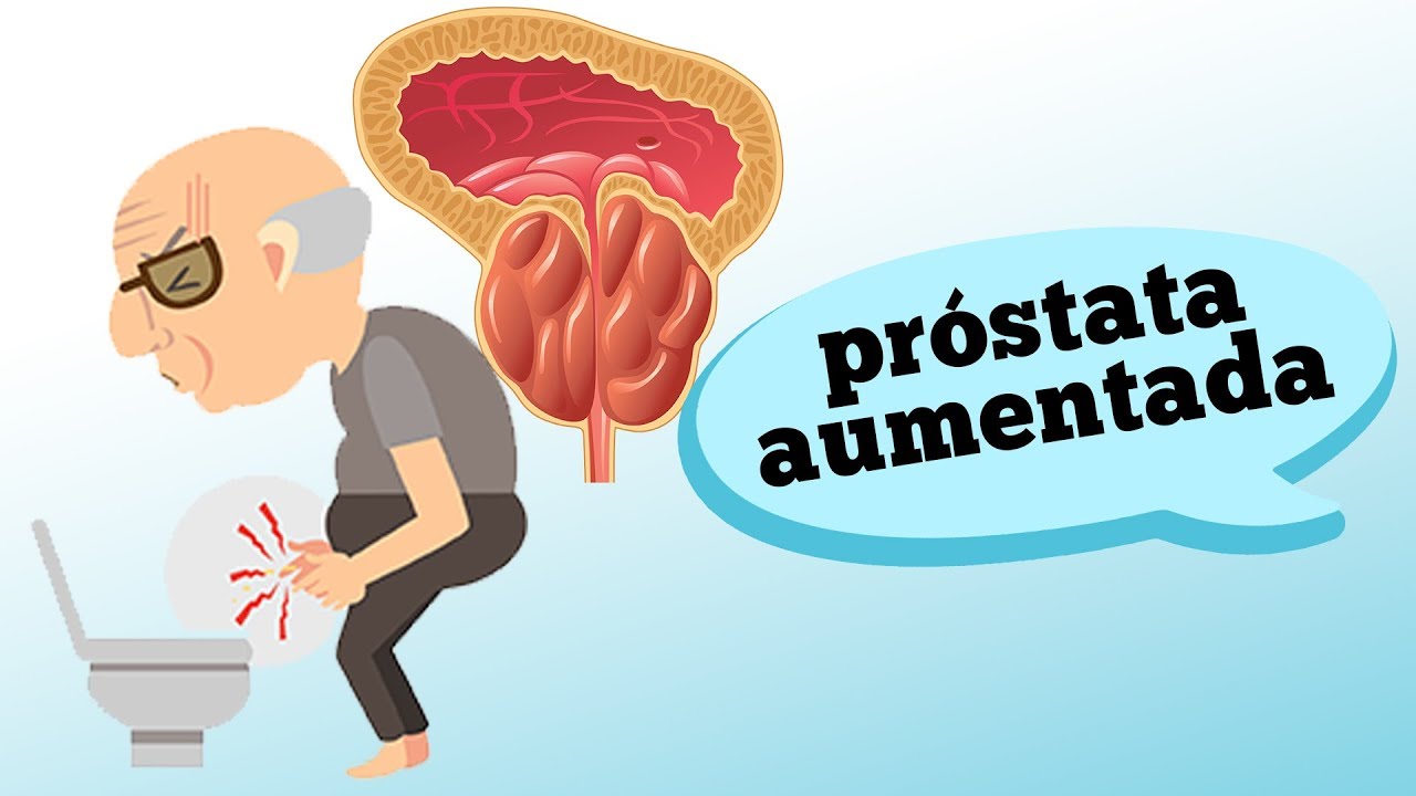 HPB Entenda o que é a próstata aumentada HPB Entenda o que é a próstata aumentada