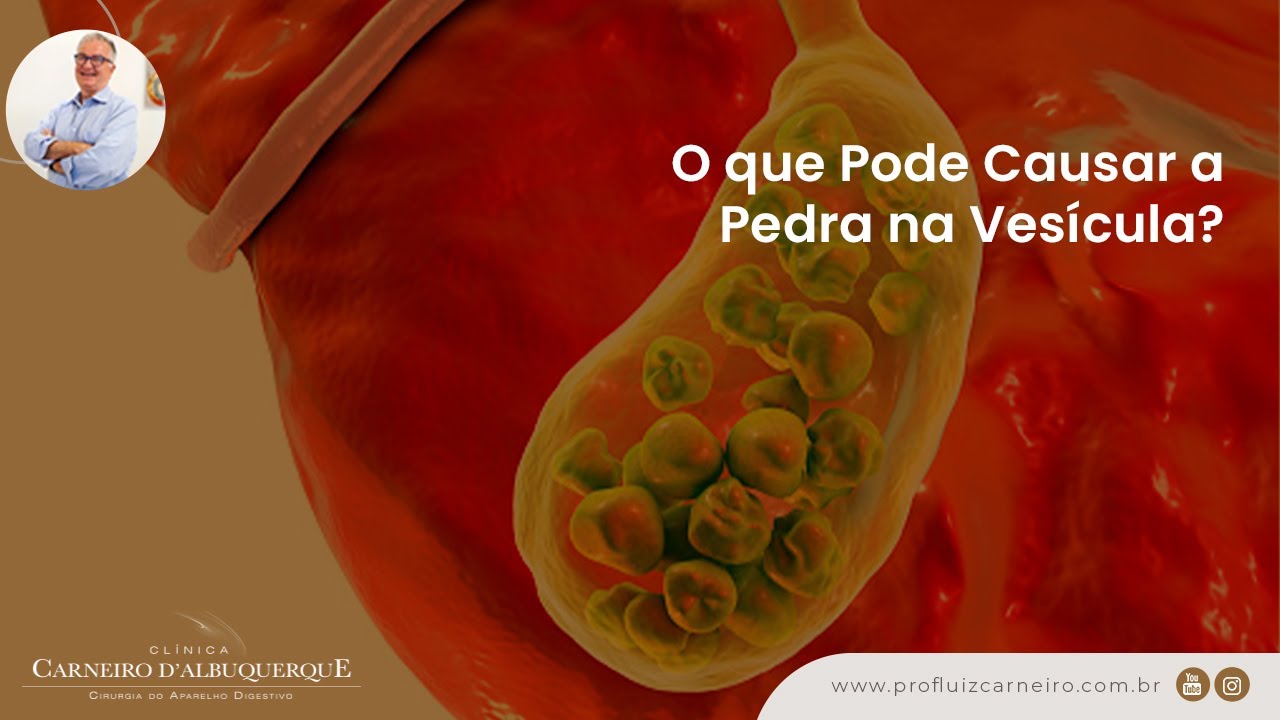 Pedra na Vesícula: Causas e Sintomas - Prof. Dr. Luiz Carneiro CRM 22761