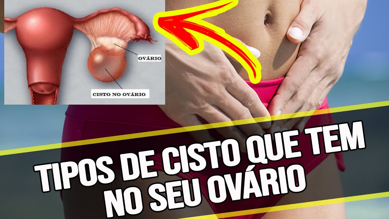 Tipos de cisto no ovário: conheça mais sobre essa condição médica ...