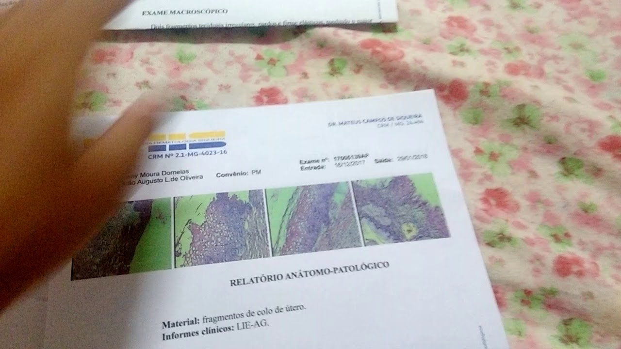 Resultado da biópsia do colo do