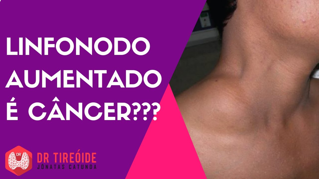 Linfonodo Calcificado é Câncer - RETOEDU