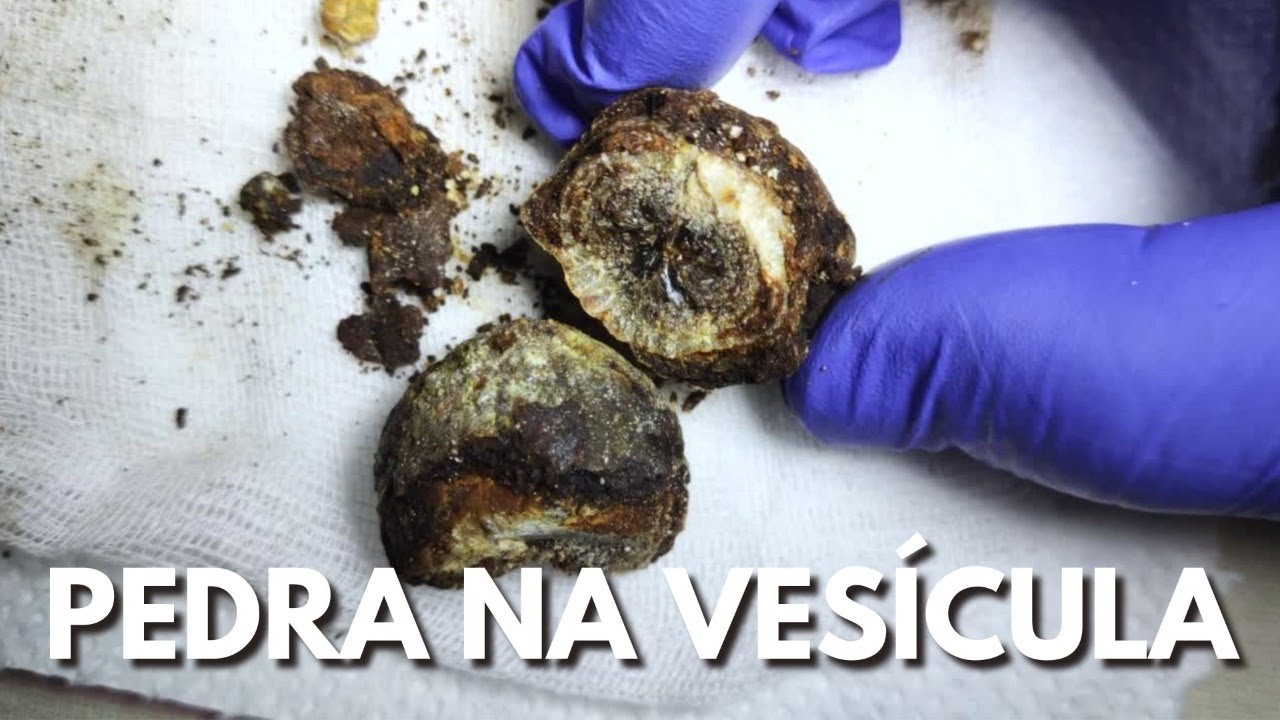 Cirurgia De Pedra Na Ves Cula Riscos E Necessidade