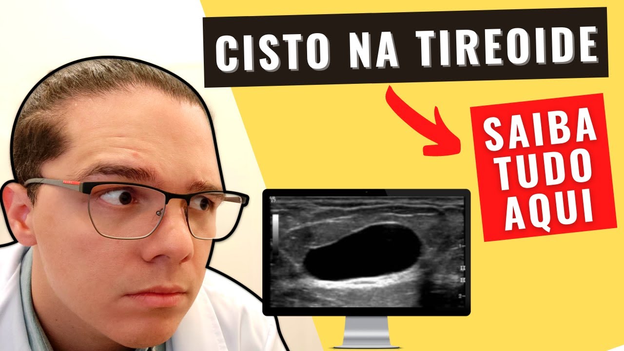 Cisto na tireoide: sintomas, tratamento e relação com câncer de tireoide