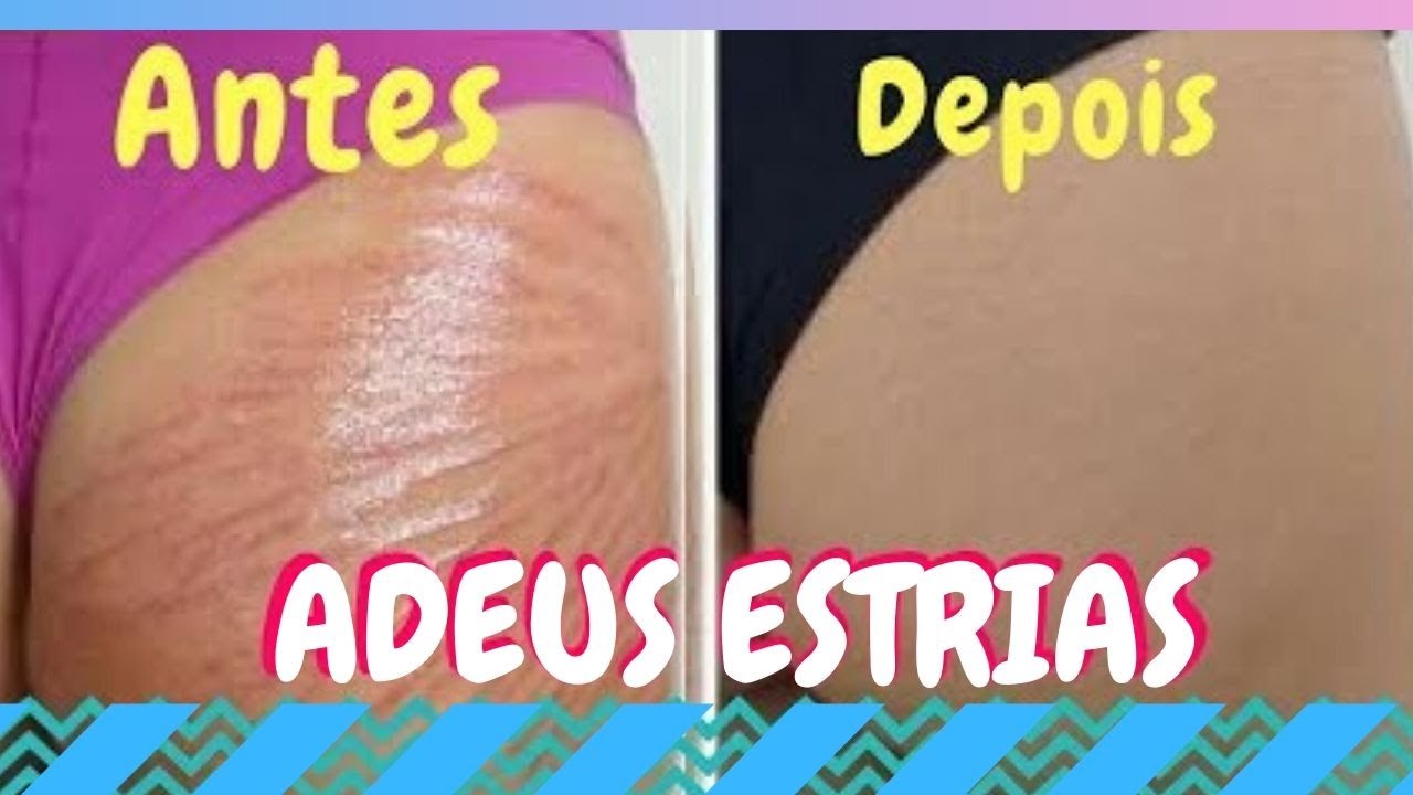 Como eliminar estrias de forma eficaz em poucos dias - Guia completo