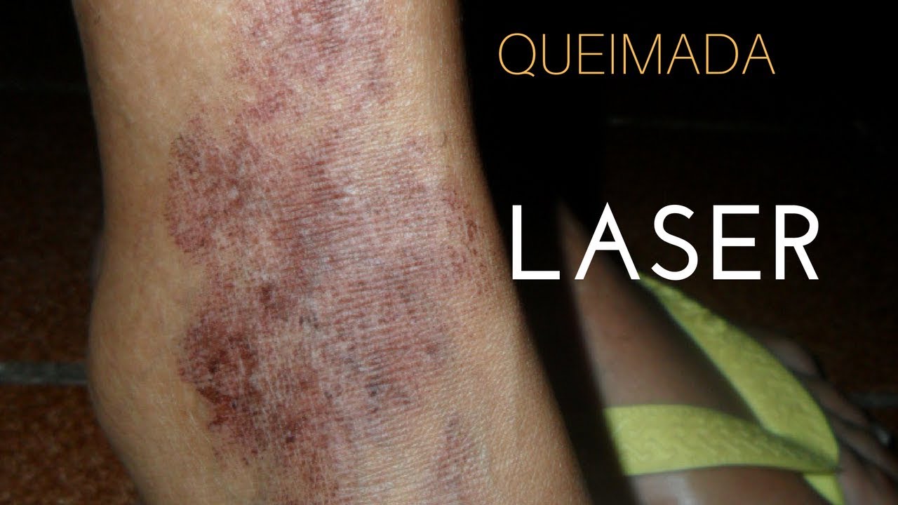 Como lidar com queimaduras por laser dicas e tratamentos adequados