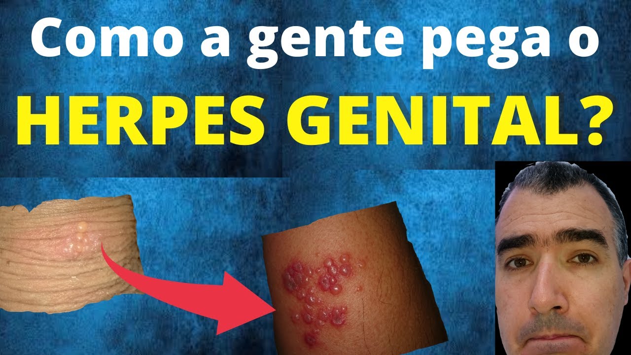 Como ocorre a transmissão do herpes genital?