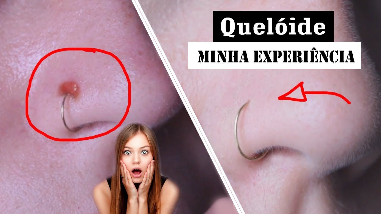 Como remover queloide do nariz: dicas de Paula Borges