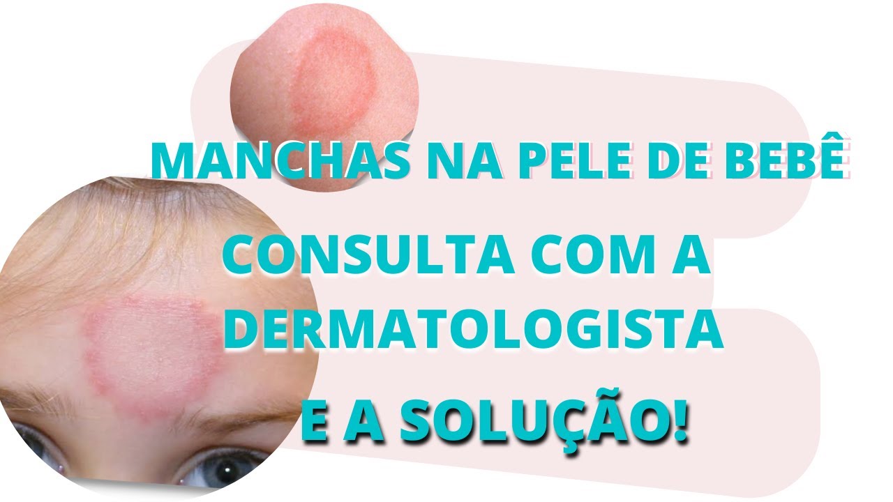 Como tratar manchas na pele de bebê com a ajuda de uma dermatologista
