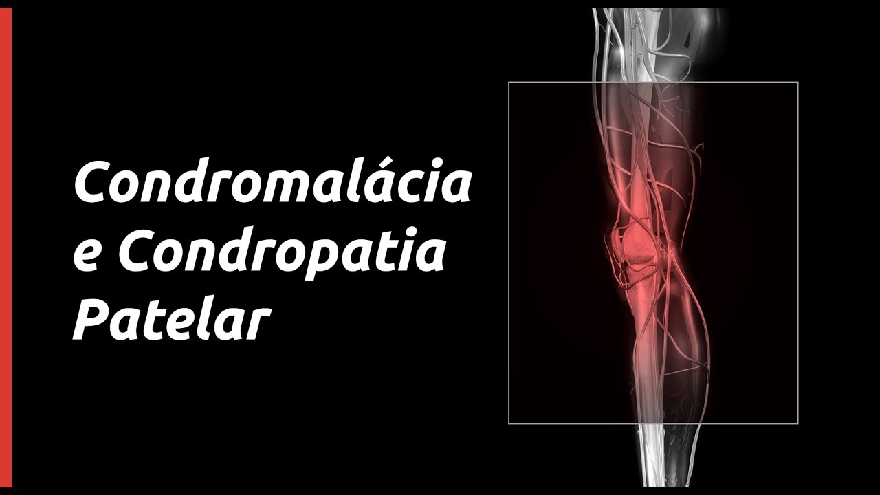 Condromalácia e condropatia patelar conheça todos os detalhes e informações importantes