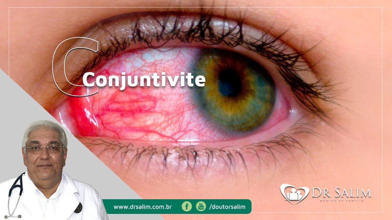 Conjuntivite - Tratamento e Orientação | Dr. Salim CRM 43.163