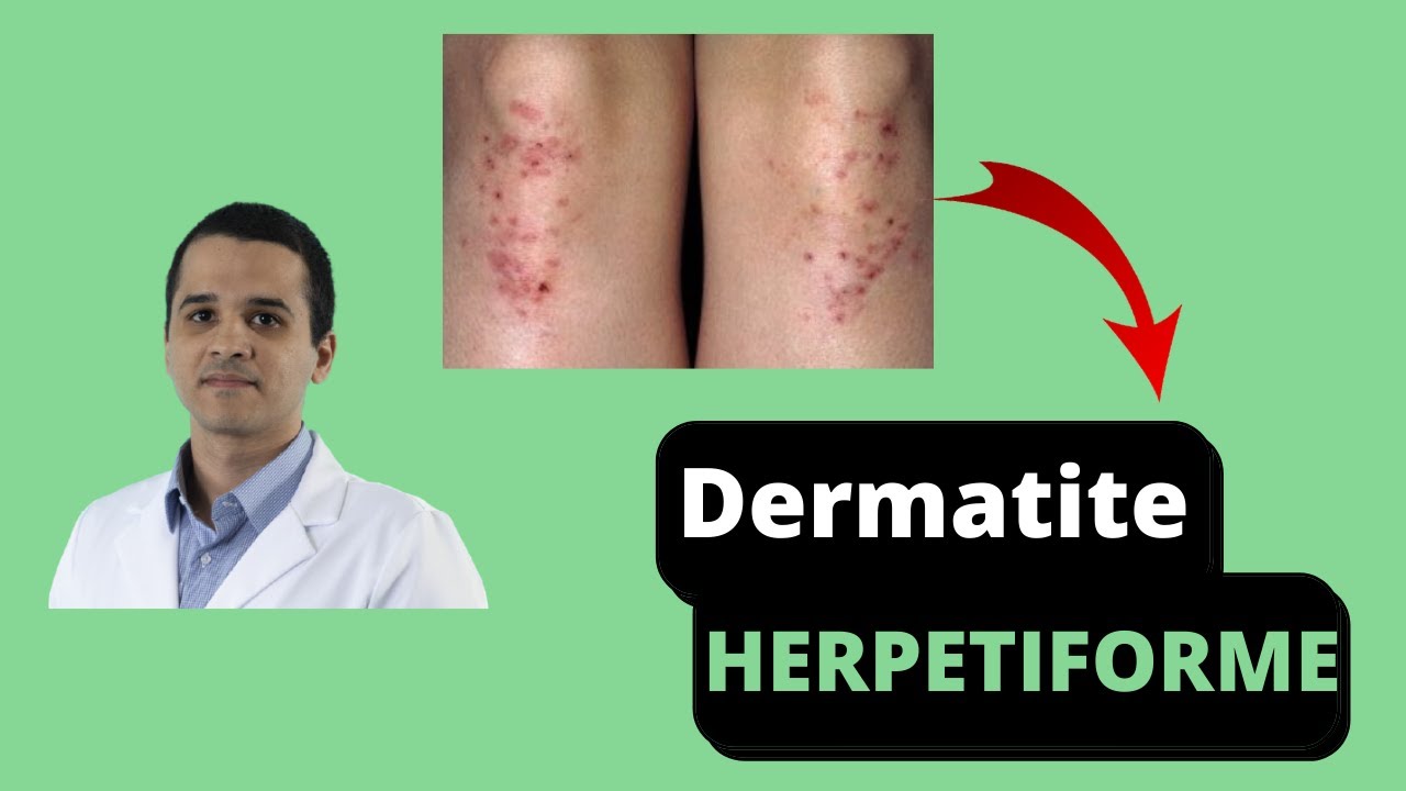 Dermatite Herpetiforme: Relação E Sintomas Da Doença Celíaca.