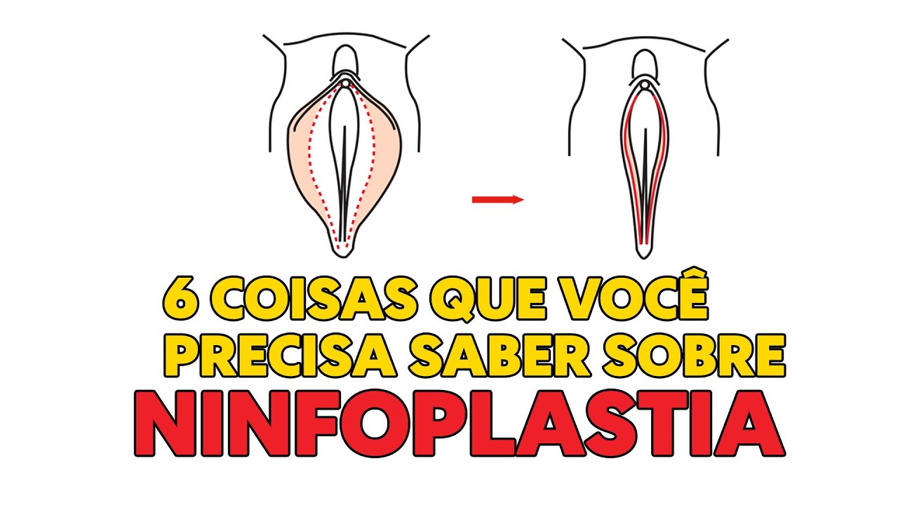 Dicas importantes para a cirurgia íntima de ninfoplastia