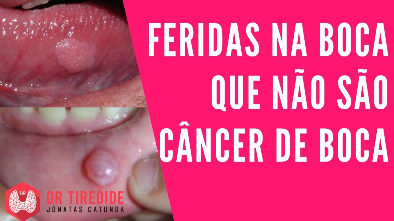 Feridas e lesões bucais não cancerígenas | Dr. Jônatas Catunda