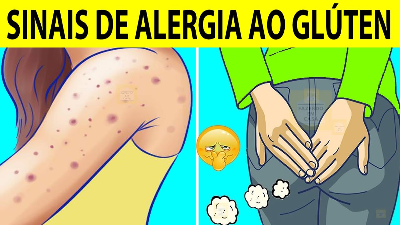 Intolerância ao glúten: 6 sinais que muitos ignoram