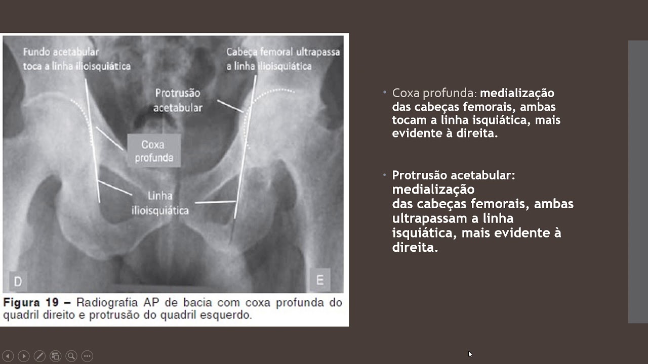 Radiografia De Bacia Principais Pontos A Serem Avaliados Resumo E Guia Completo 9945