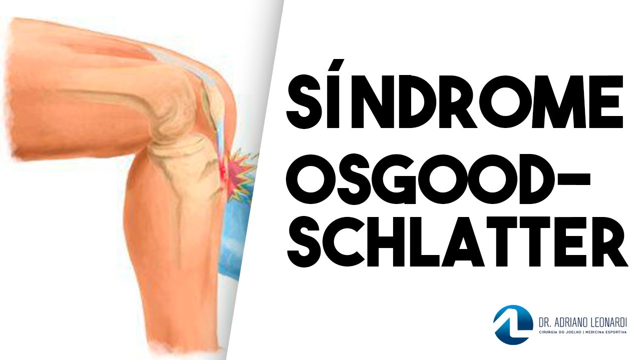 Síndrome de OsgoodSchlatter Causas, sintomas, diagnóstico