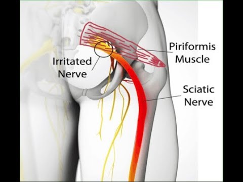 Síndrome do Piriforme Liberação Miofascial para a Dor Ciática Clínica de Fisioterapia Dr