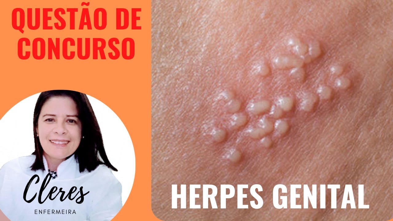 Herpes Genital Causas Sintomas E Tratamentos Eficazes